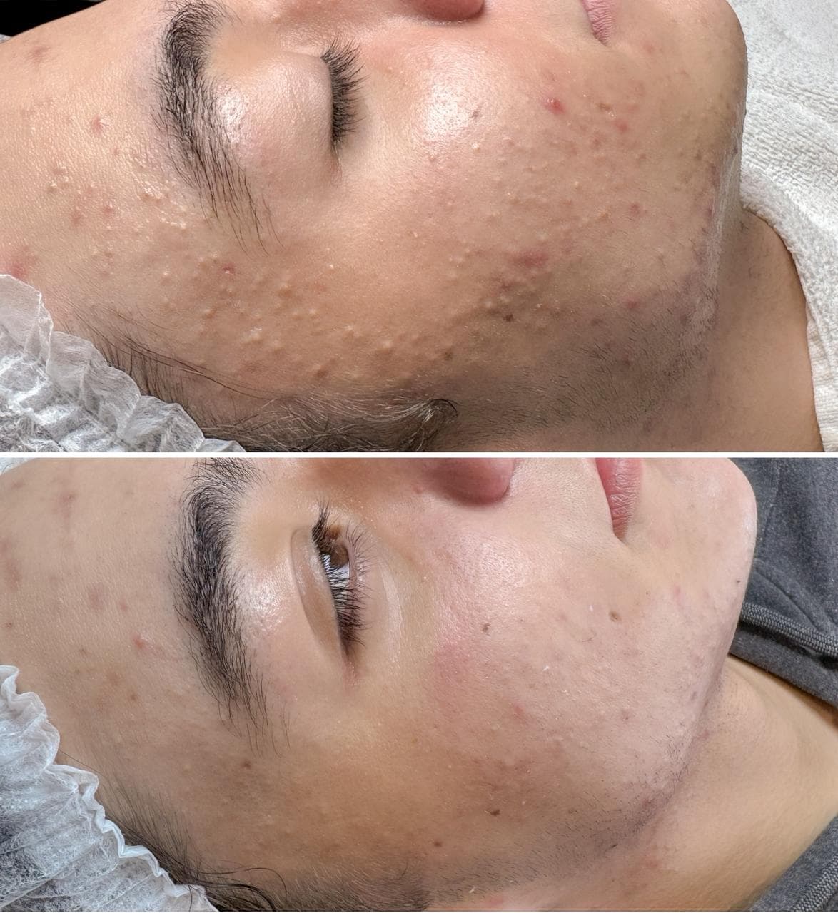 Limpeza de Pele